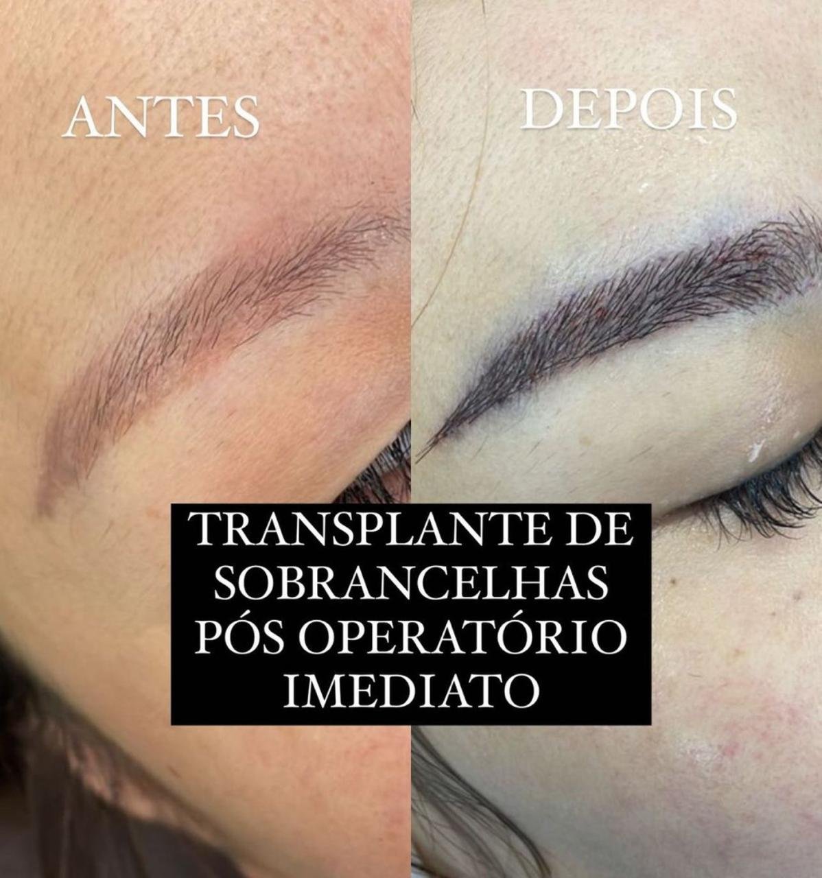 Principais Diferenças Entre a Micropigmentação de Sobrancelhas e o Transplante Permanente de Sobrancelhas Método FUE Asiático